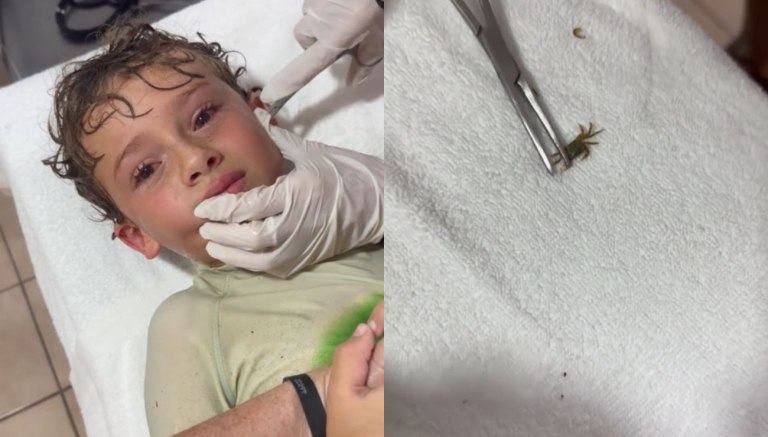 Μεξικό: Καβούρι μπήκε στο αυτί ενός αγοριού  Βίντεο από τη στιγμή που οι γιατροί το βγάζουν ζωντανό