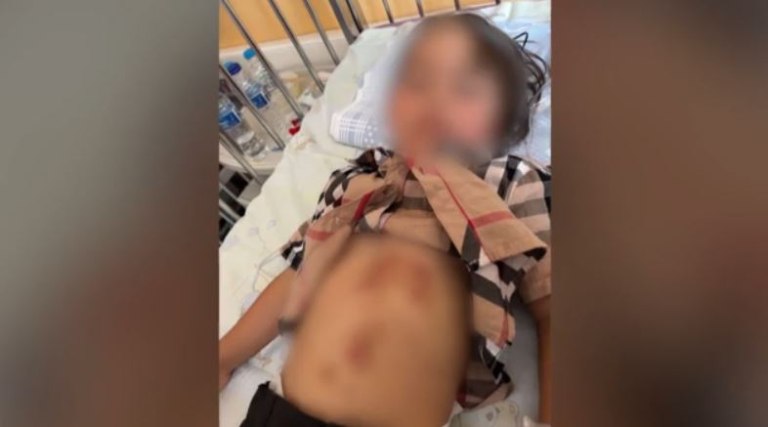 Χαλκιδική: Βίντεο με τον λύκο που επιτέθηκε και τραυμάτισε 5χρονη  Εικόνες από τα τραύματα στο κοριτσάκι