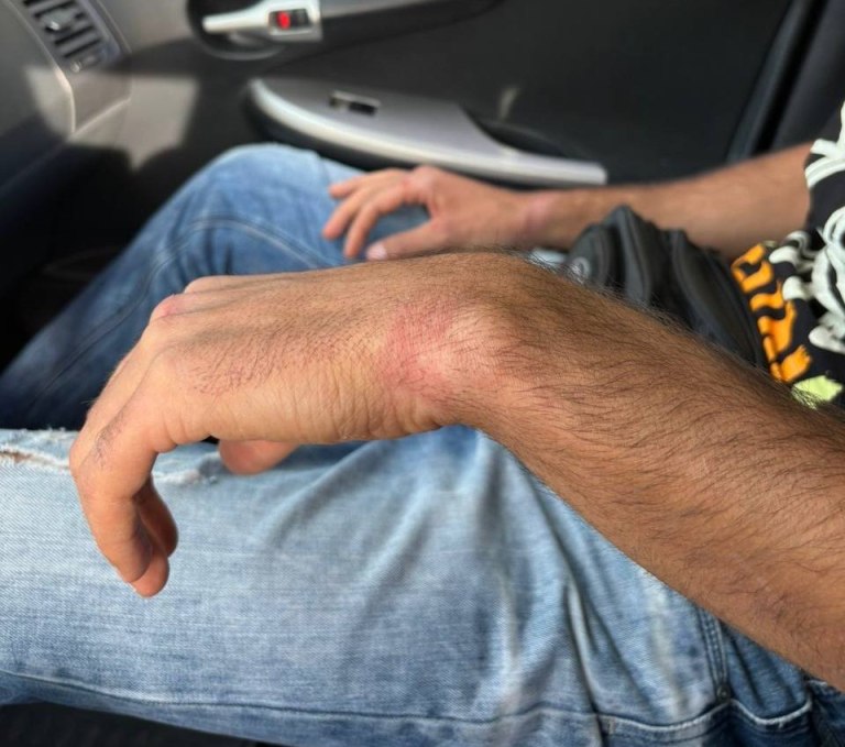 Ξάνθη: Mε σκλήρυνση κατά πλάκας ο 40χρονος που δέχτηκε επίθεση από αστυνομικό  Θύμα και δικηγόρος μίλησαν στο in